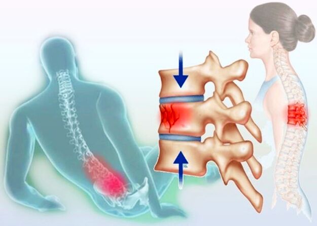 Dokonce i obyčejné zranění může vyvolat rozvoj osteochondrózy