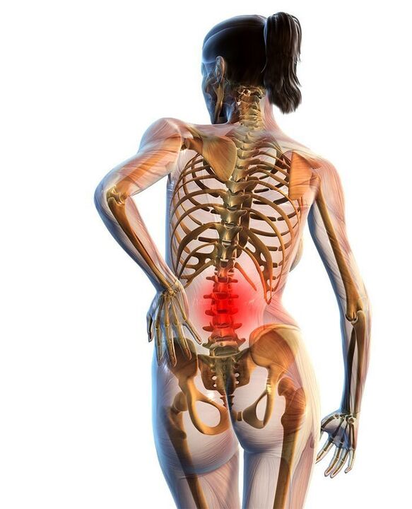 Nejčastěji se vyskytuje osteochondróza bederní páteře